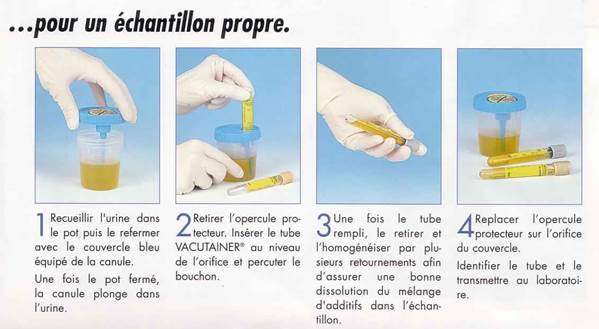 Comment interpréter les résultats d'une analyse d'urine (ECBU) ?